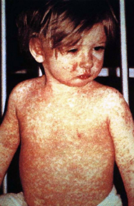 This child shows the classic four-day measles rash. (Photo by Barbara Rice/CDC/NIP, PD-US Gov)