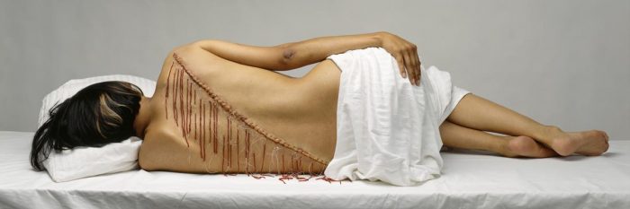Woman photographed from the back with fringe-like scars
